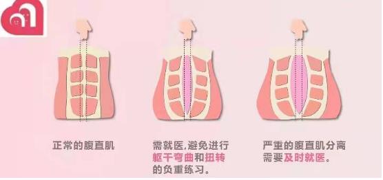 什么是腹直肌分离，你知道吗？